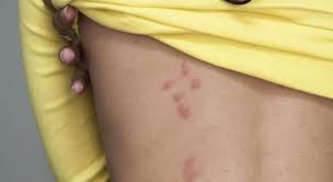 Mosquito bite symptoms only female mosquitoes bite. How Long Do Bed Bug Bites Last Ehrlich Pest Control Blog