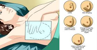 Irregularities, like lumps and bumps, are, after all, the most common thing. Early Signs And Symptoms Of Breast Cancer