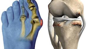 La douleur et la gêne dans les mouvements du genou. Schmerzhafte Arthrose Wenn Sich Die Knorpel In Den Gelenken Abreiben Welt
