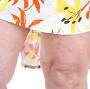 treatment for spider veins from my.clevelandclinic.org