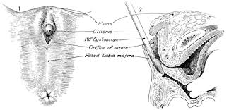 Image result for Labial Fusion
