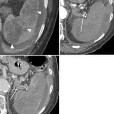 Old Granulomatous Disease Axial Ct Image Shows Multiple Small High Download Scientific Diagram