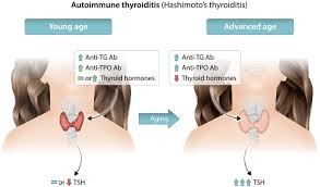 Image result for Thyroiditis