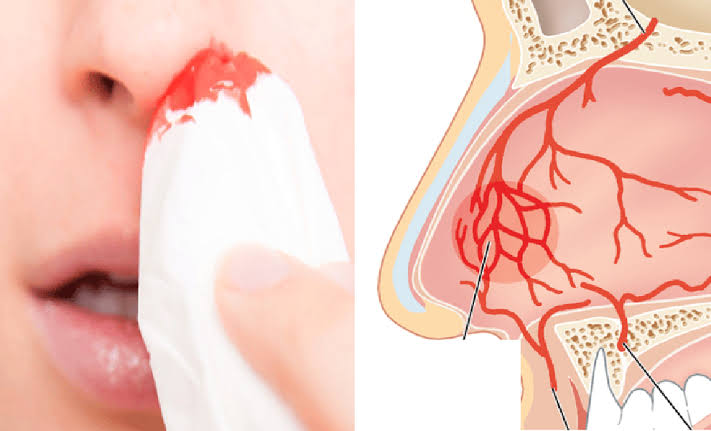 Bị chảy máu cam, bình tĩnh xử trí với cách làm này