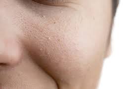 Jul 08, 2021 · natural remedies have been suggested to get rid of milia, although the research on their effectiveness is limited. Re How To Get Rid Of Milia Little Whit Beauty Insider Community