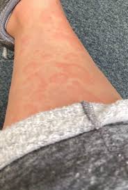 We did not find results for: Skin Rash Should Be Considered As A Fourth Key Sign Of Covid 19