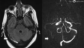Cvst is a rare form of. Cerebral Venous Sinus Thrombosis Causing Intracranial Hypertension