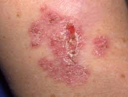 Jutras family keeps kyle's legacy alive sarasota — shortly after he started treatment last year for nut midline carcinoma, a cancer that ultimately would claim his life, kyle jutras had a conversation with his dad, rob. Keratinocyte Cancer Dermnet Nz