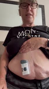 What is the experience like with the on-body injector for Skyrizi infusions?