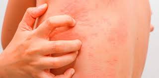 Epidermolisis Bullosa Piel De Mariposa Distrofica Recesiva Y Dominante