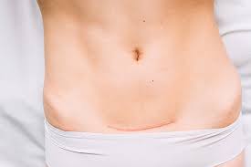 Regular vaginal secretions are expected to change in terms of what causes a smelly brown discharge after my period is over? Bleeding After C Section How Long Does It Happen Geburtszeit Com
