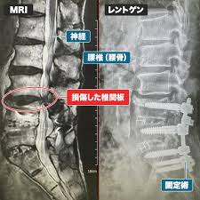 腰椎 固定 術 再 手術 ブログ
