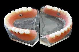 Image result for dentures