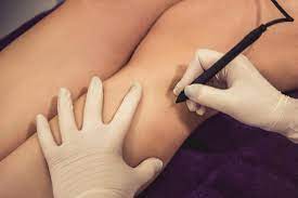 Electrolysis hair removal is a permanent procedure, but it is very exact, thus takes time. Laser Hair Removal Vs Electrolysis What Is The Difference