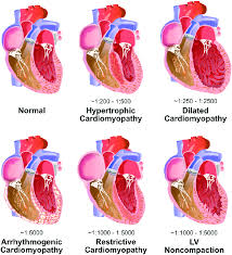 Image result for Restrictive Cardiomyopathy
