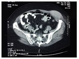 Unusual Radiologic Presentations Of Malignant Peritoneal Mesothelioma