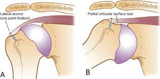 Partial Thickness Rotator Cuff Tears Musculoskeletal Key