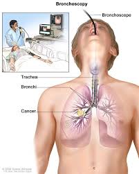 Because there are very few nerve endings in the lungs, a tumor could grow without causing pain or discomfort. Cancerhelp Online Nci Cancer Diagnosis And Treatment
