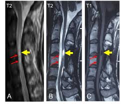 Image result for Spinal Trauma