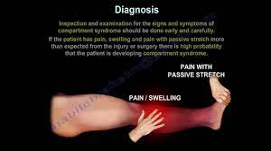 Compartment Syndrome Physiopedia