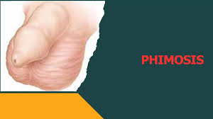 Image result for Phimosis