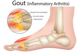 Image result for gout
