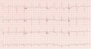 Respirační insuficience (ri) neboli dechová nedostatečnost je neschopnost respiračního systému zajistit adekvátní výměnu plynů. Ekg Kazuistika 12 Pacientka S Hypotenzi Kardioblog