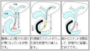 「胆管がん」の画像検索結果