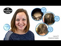 The clinic and team are fantastic and although it is expensive, it is well worth the money and the only thing that's ever helped in treating hair loss. Belgravia Hair Clinic Cost Novocom Top