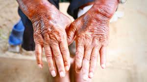 Image result for Systemic Sclerosis