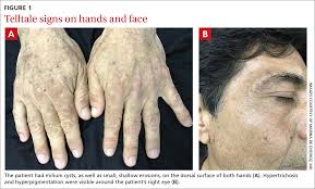 Image result for Hypertrichosis