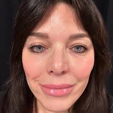 Look at that LaseMD Glo! Lutronic LaseMD can give you that glow, reduce  fine lines, wrinkles, & sunspots with NO DOWNTIME.