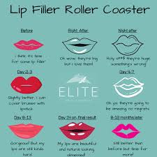 The lip filler procedure only takes a few minutes and is less invasive. Tips To Reduce Lip Filler Swelling And Bruising Elite Medical Aesthetics