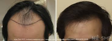 In most cases it is vertex and front.temples which goes first. Hair Transplant In Asian Men With Before After Photos Wrassman M D Baldingblog