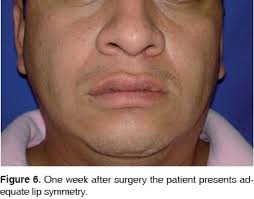 Lip pleomorphic adenoma