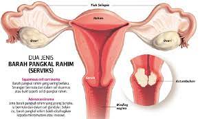 Faraj berbau jika adanya jangkitan bakteria. Ujian Pap Smear Boleh Cegah Kanser Serviks