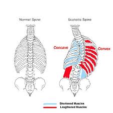 Scoliosis Curves And Shortened Muscles Scoliosis Exercises Scoliosis Treatment Scoliosis