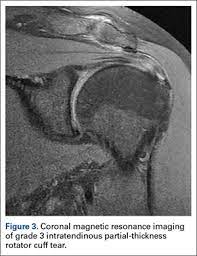 High Grade Articular Bursal And Intratendinous Partial Thickness Rotator Cuff Tears A Retrospective Study Comparing Functional Outcomes After Completion And Repair Mdedge Surgery