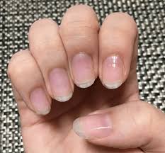 ネイルベットを伸ばす 深爪矯正を自力でした結果 8ヶ月で綺麗な爪に ブログでbefore after大公開 かんとら 綺麗な爪 深爪 ネイル