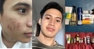 Nak pilih pencuci muka senang je actually. Segan Nak Selfie Sebab Muka Ketiak Lelaki Ini Dedah Produk Untuk Pulih Wajah Breakout Dalam Masa 4 Bulan Hijabista