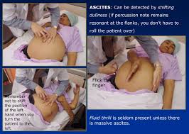 Image result for Shifting Dullness Test