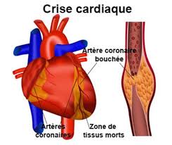 L'infarctus du myocarde est provoqué le plus souvent par un caillot qui oblitère la lumière d'une artère coronaire, qui est l'artère qui irrigue le muscle cardiaque. Infarctus Du Myocarde Crise Cardiaque Symptomes Traitement Definition Docteurclic Com