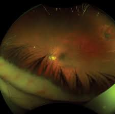This is the most common type of retinal detachment. Urgent Flashes And Floaters