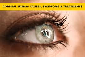 Image result for Cornea