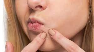 Skin Picking Sichtbare Hautschaden Sind Ein Alarmsignal
