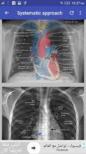 Chest x ray is probably the most common imaging test. Chest X Ray Interpretation For Android Apk Download