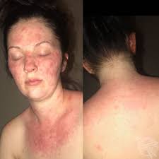 They are often pictured with swollen faces, burnt skin, ulcers, and generally appearing to look very unwell from the reaction. This Mother Suffered Unbelievable Scarring After Using Hair Dye That Triggered A Severe Allergic Reaction Leaving Rashes And Burns Media Drum World