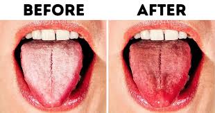 If you brush regularly, dental plaque isn't a problem. 10 Ways To Get Rid Of White Tongue And Make It Healthier