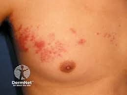 Image result for zoster under breasts