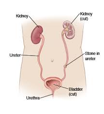 Kidney Stone With Pain
